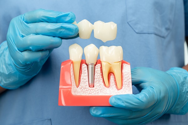 Recovery Tips After Getting Dental Implants